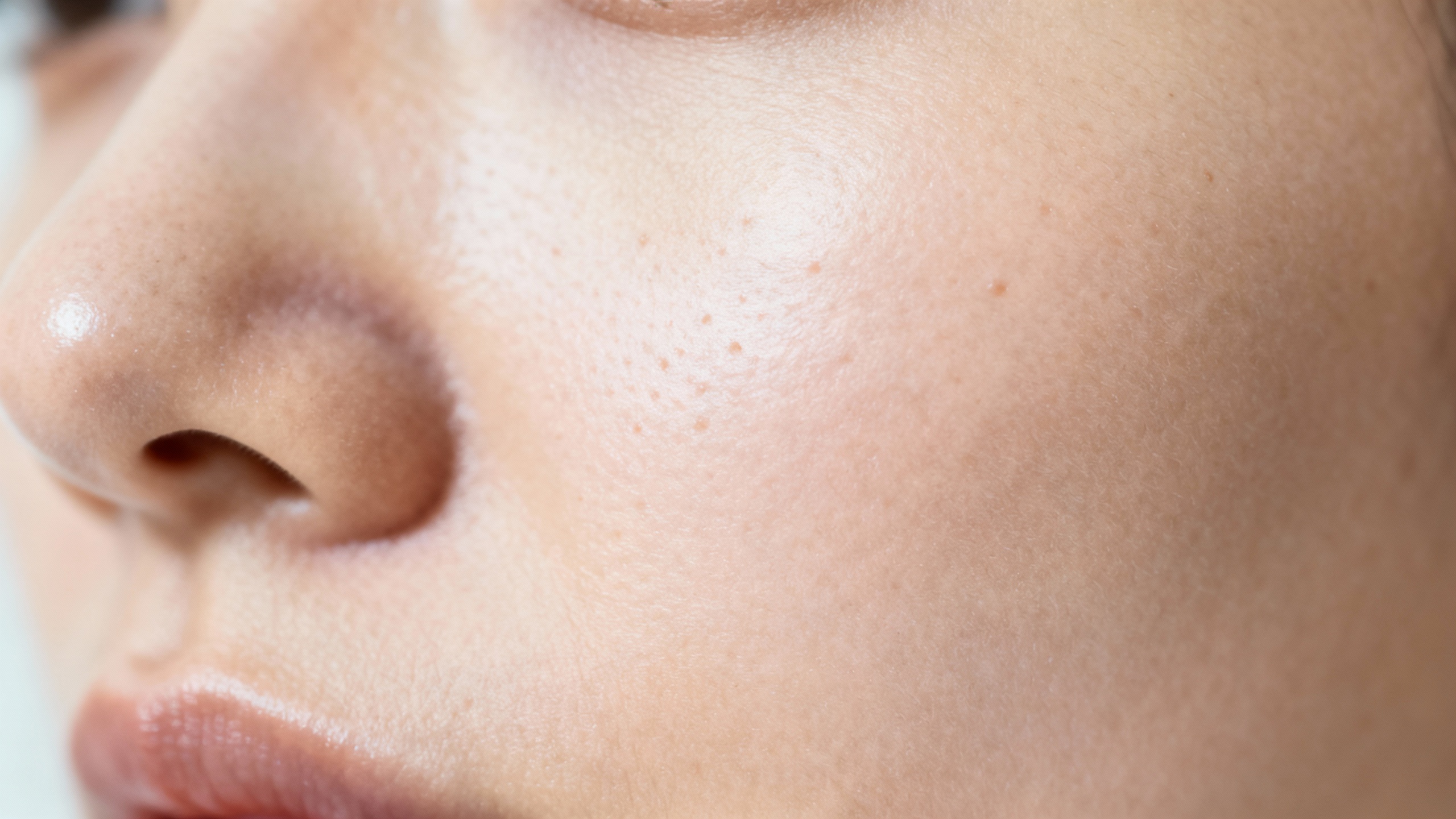 Featured image for What causes recurring acne?